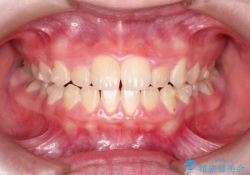 [10代女性] マウスピース矯正 すきっ歯とクロスバイトの治療中