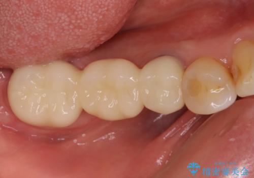 歯茎から異臭がする　大きな虫歯を抜歯してオールセラミックブリッジへの治療後