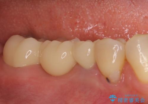 歯茎から異臭がする　大きな虫歯を抜歯してオールセラミックブリッジへの治療後