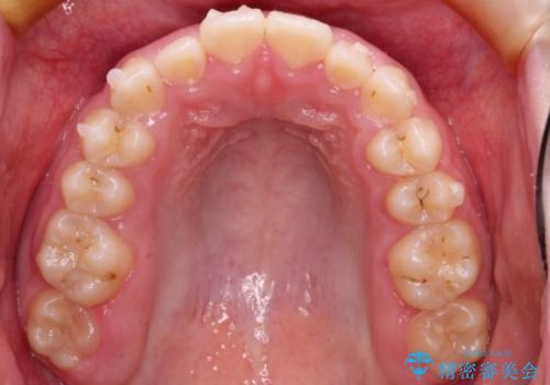 [10代女性] マウスピース矯正 すきっ歯とクロスバイトの治療中