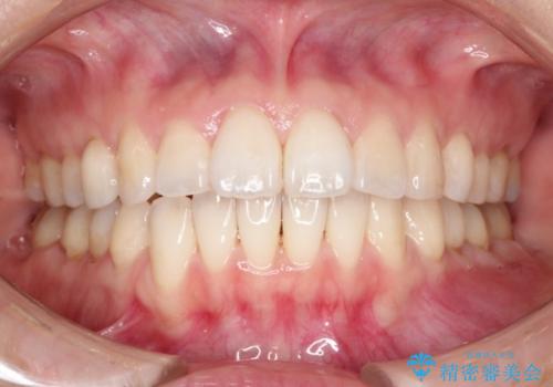 インビザライン・非抜歯　出っ歯とガタつきの矯正治療の治療後