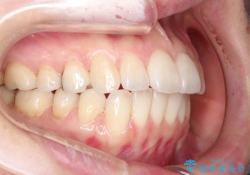 インビザライン・非抜歯　出っ歯とガタつきの矯正治療の治療後