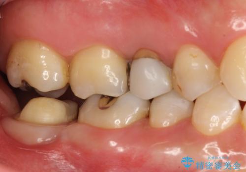 咬むと痛い　根管治療のやり直しと歯周外科を含む徹底的な治療の治療中