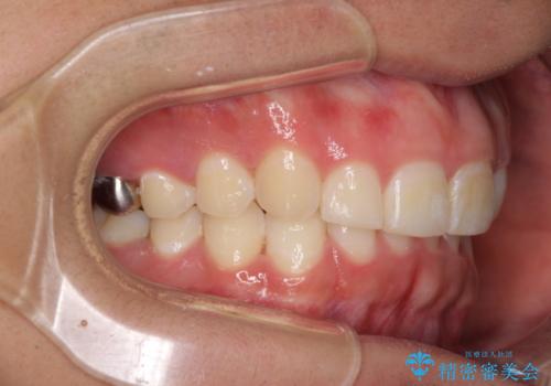 インビザライン・ライトによる、軽度な歯列不正の解消の治療後