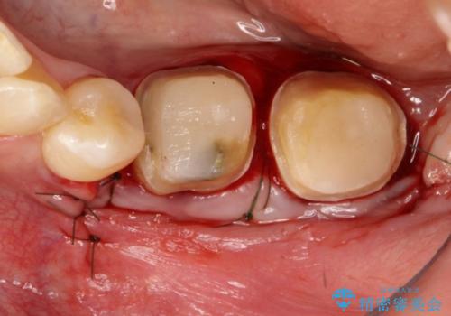 感染を生じている奥歯の根本的な治療→かみ合わせの回復の治療中