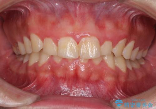 インビザライン・ライトによる、軽度な歯列不正の解消の症例 治療前