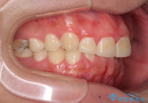 インビザライン・ライトによる、軽度な歯列不正の解消の治療前