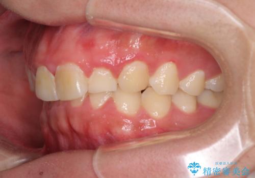 インビザライン・ライトによる、軽度な歯列不正の解消の治療前