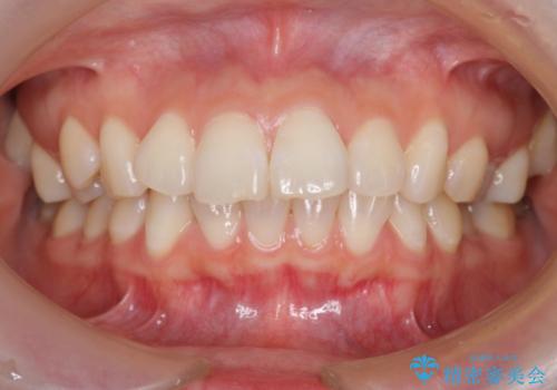出っ歯の治療　前から5番目の歯を抜歯　すれ違い咬合もの治療前