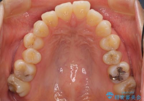 出っ歯の治療　前から5番目の歯を抜歯　すれ違い咬合もの治療前