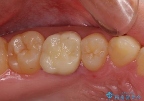 根管治療後の奥歯のセラミッククラウン治療　歯肉からの出血が改善