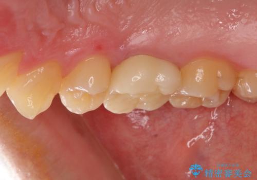 根管治療後の奥歯のセラミッククラウン治療　歯肉からの出血が改善の治療後