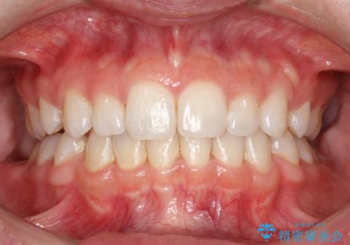 上下裏側矯正　フルリンガルによる上下前歯前突の歯列矯正の治療後