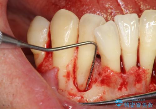 インプラント・再生治療を応用した全顎的重度歯周病治療