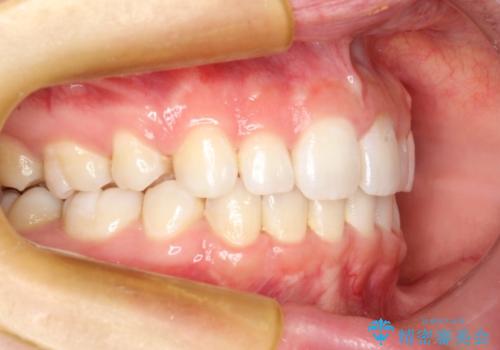 上下裏側矯正　フルリンガルによる上下前歯前突の歯列矯正の症例 治療後