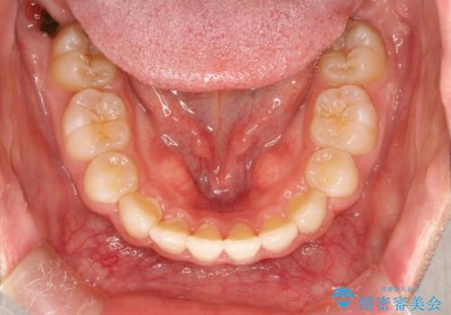 上下裏側矯正　フルリンガルによる上下前歯前突の歯列矯正の治療後