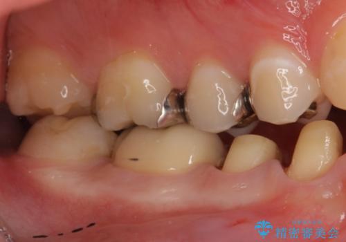 銀歯をセラミックで白い歯へ　虫歯もきっちりとりますの治療中