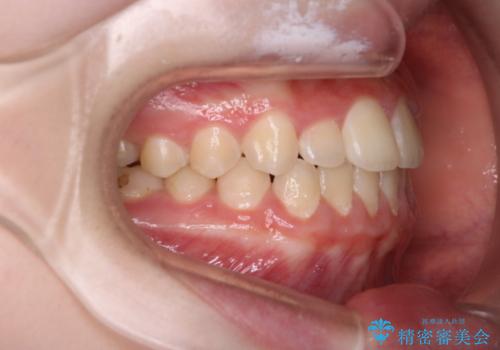 [10代女性] マウスピース矯正 すきっ歯とクロスバイトの治療後