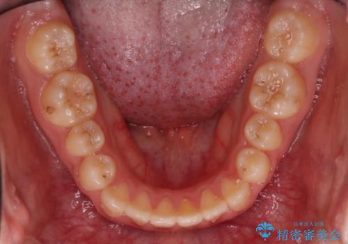 [10代女性] マウスピース矯正 すきっ歯とクロスバイトの治療後