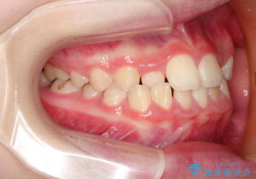 [10代女性] マウスピース矯正 すきっ歯とクロスバイトの治療前