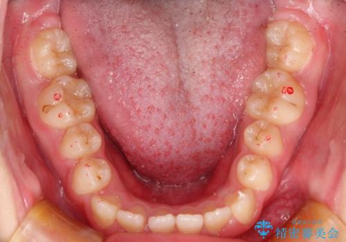 [10代女性] マウスピース矯正 すきっ歯とクロスバイトの治療前