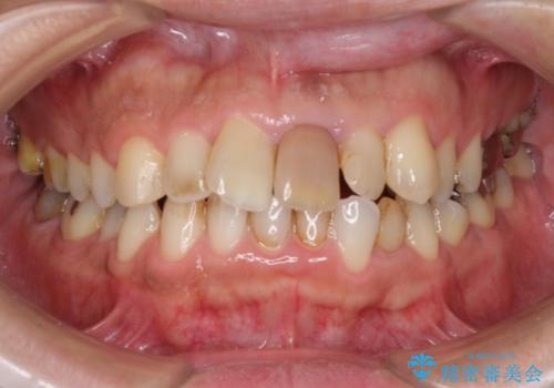 昔ぶつけた前歯が変色してきた　セラミック治療の治療前