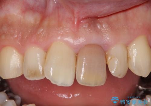 昔ぶつけた前歯が変色してきた　セラミック治療の治療前