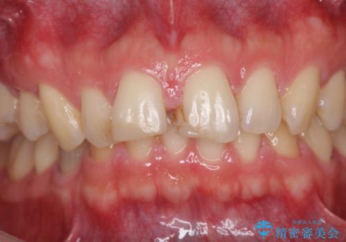 結婚式間近の審美治療　すきっ歯をオールセラミックで自然な口元にの治療前