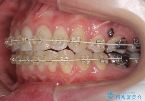出っ歯の治療　最小限の抜歯の治療中