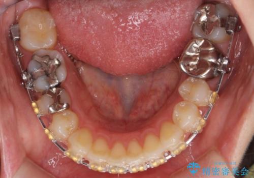 出っ歯の治療　最小限の抜歯の治療中