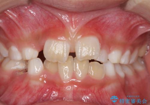 子どもの治療　すきっ歯を防止する予防治療　上唇小帯切除の治療前
