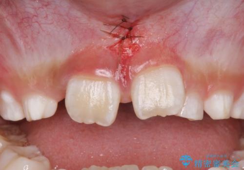子どもの治療　すきっ歯を防止する予防治療　上唇小帯切除の治療中