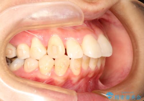 出っ歯が気になる　インビザラインによる目立たない矯正の治療中