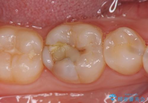 セラミックインレー修復　虫歯をとって白い歯への治療前