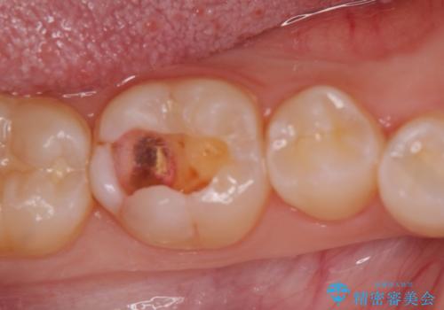セラミックインレー修復　虫歯をとって白い歯への治療中