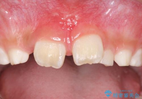 子どもの治療　すきっ歯を防止する予防治療　上唇小帯切除の治療後