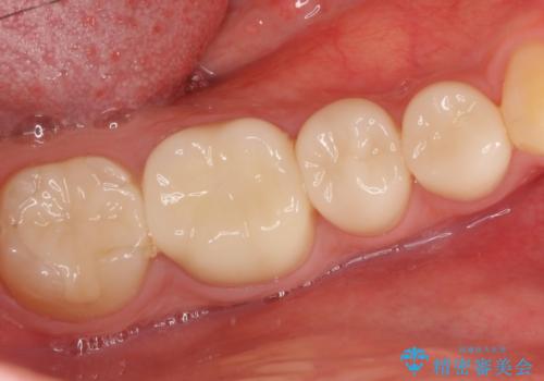 銀歯をセラミックで白い歯へ　虫歯もきっちりとりますの治療後