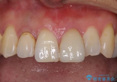 前歯が歯茎の中で折れた　部分的矯正を併用したかぶせ物の治療の治療前