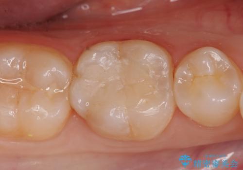 セラミックインレー修復　虫歯をとって白い歯への治療後