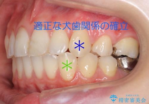 出っ歯の治療　最小限の抜歯の治療後