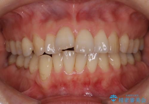 インビザライン・非抜歯　出っ歯とガタつきの矯正治療の治療前