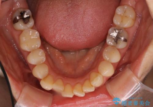 インビザライン・非抜歯　出っ歯とガタつきの矯正治療の治療前