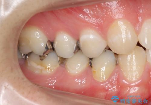 銀歯をセラミックで白い歯へ　虫歯もきっちりとりますの治療前
