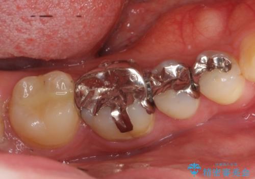 銀歯をセラミックで白い歯へ　虫歯もきっちりとりますの治療前