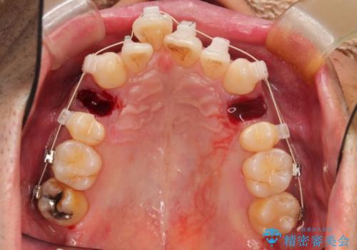 ワイヤー矯正による出っ歯の治療　表の審美装置で見た目と機能性を両立