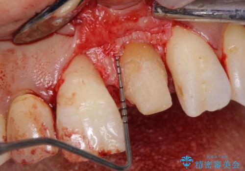 前歯が歯茎の中で折れた　部分的矯正を併用したかぶせ物の治療の治療前