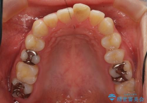 出っ歯の治療　最小限の抜歯の治療前