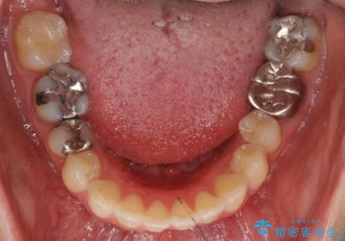 出っ歯の治療　最小限の抜歯の治療前