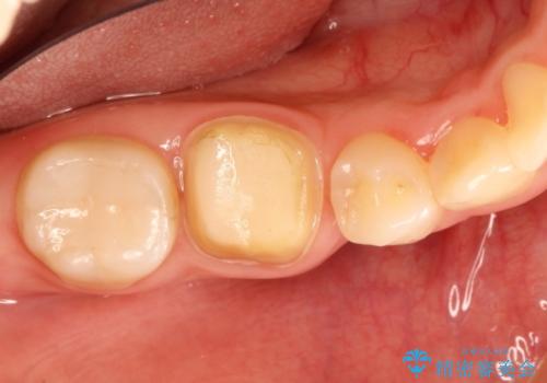 被せものが外れやすい状態を歯周外科で改善する　根管治療もやり直すの治療前