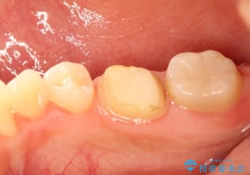 被せものが外れやすい状態を歯周外科で改善する　根管治療もやり直すの治療前